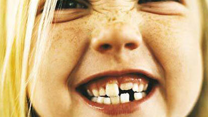 Prevent and Protect: Improving Children’s Oral Health