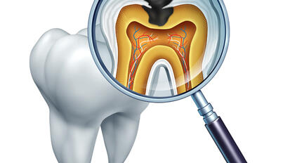 New Clinical Guidelines for Caries Management