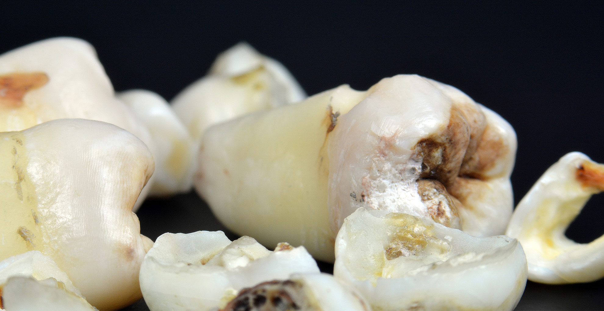 Management of Caries as a Dynamic Disease Process Management of Caries as a Dynamic Disease Process