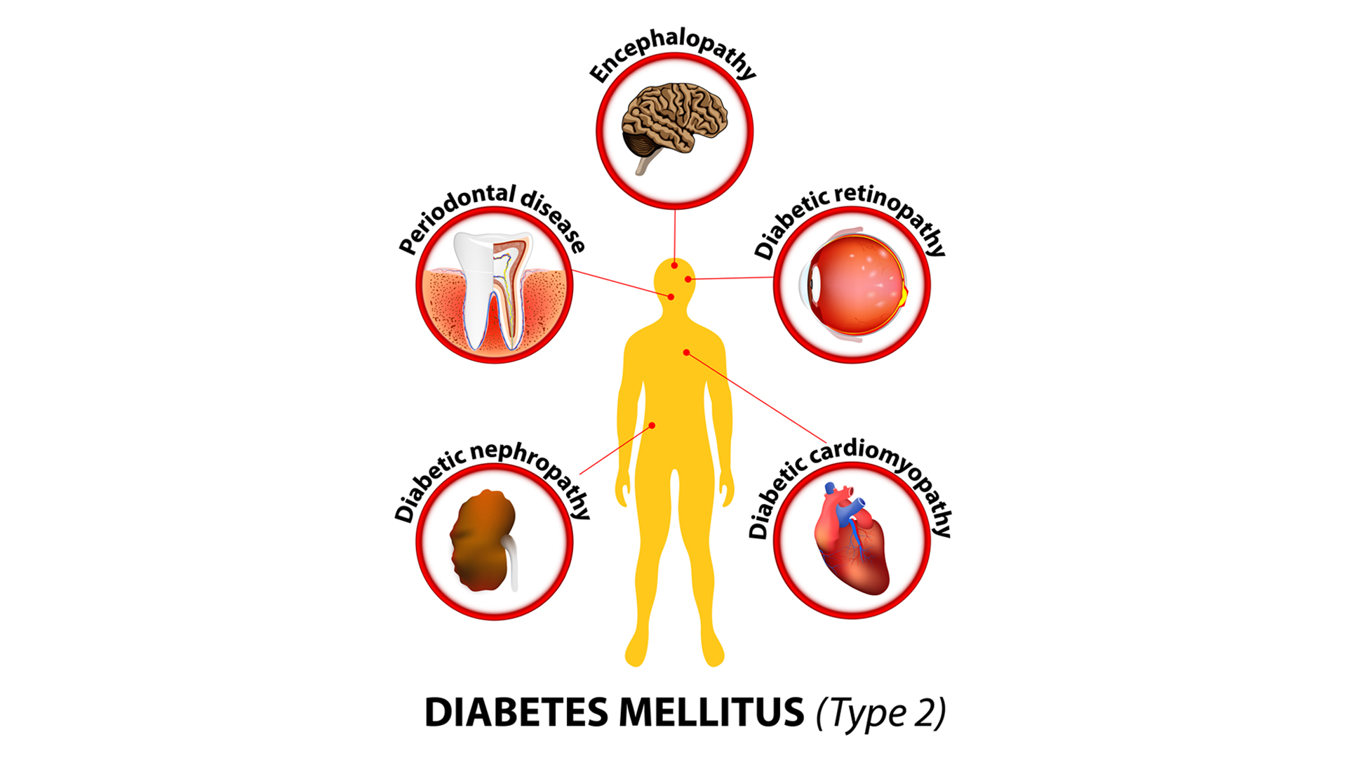 Diabetes and Oral Disease