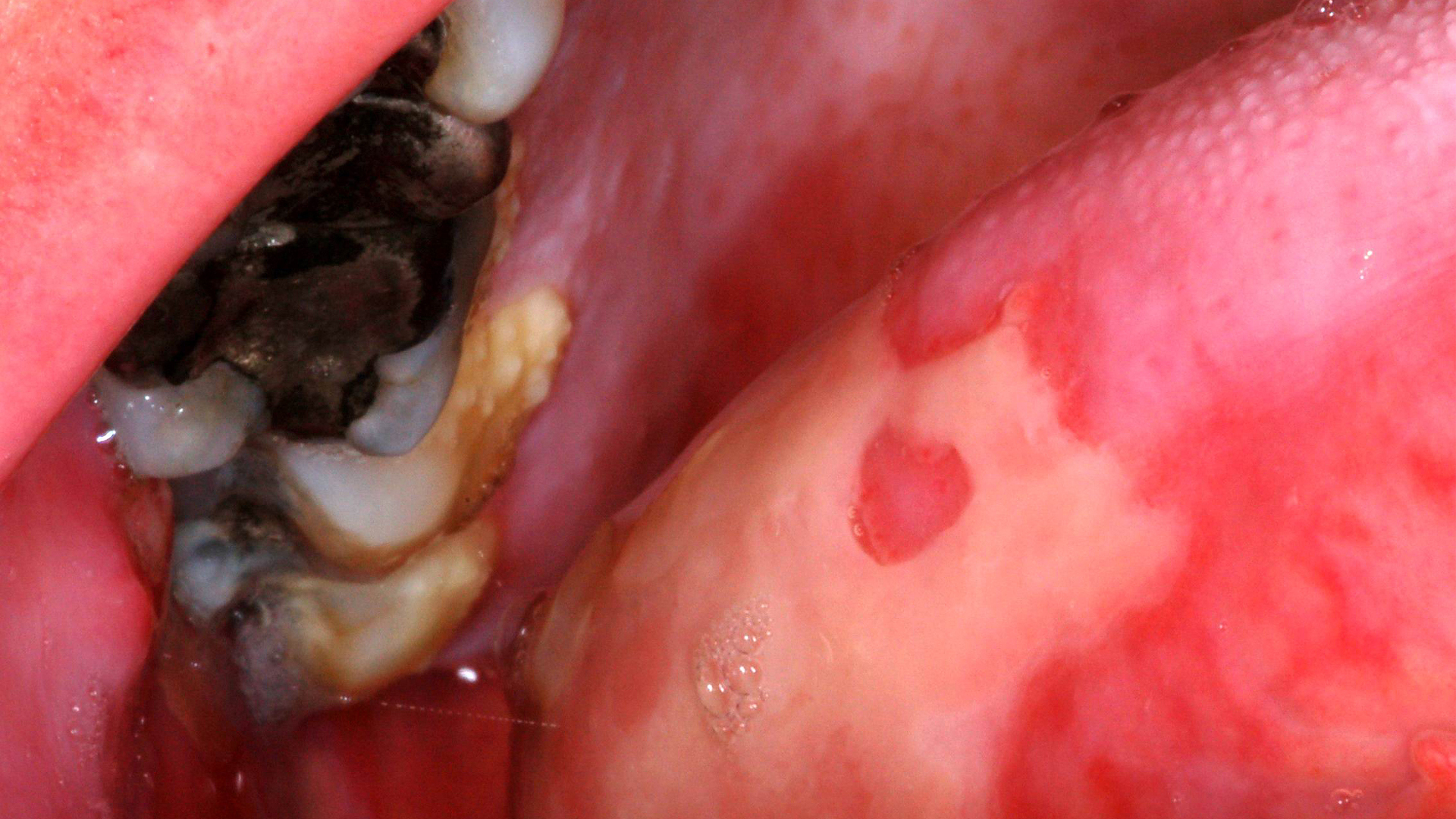 Oral Complications of Cancer Therapy Part 1: Conventional Chemotherapy and Targeted Anticancer Agents