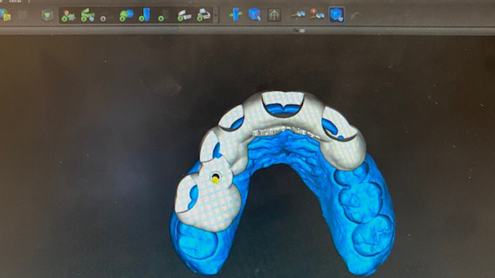 Placing an implant predictably using 3-D workflow, and surgical guide