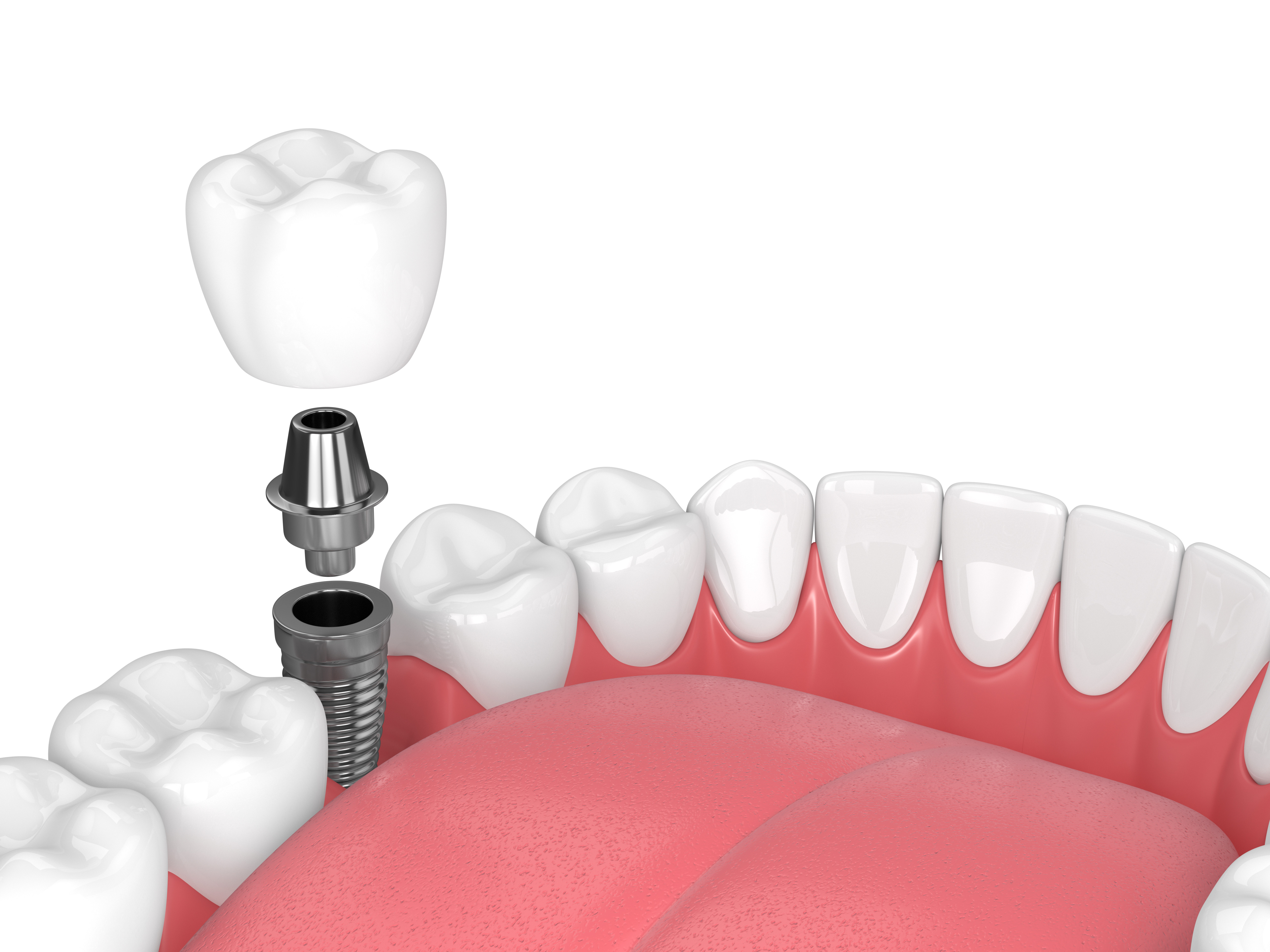 Implant Maintenance for Long Term Success