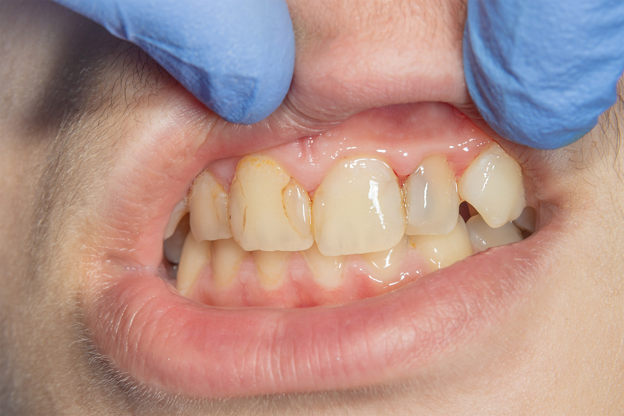 Recurrent Caries Recurrent Caries