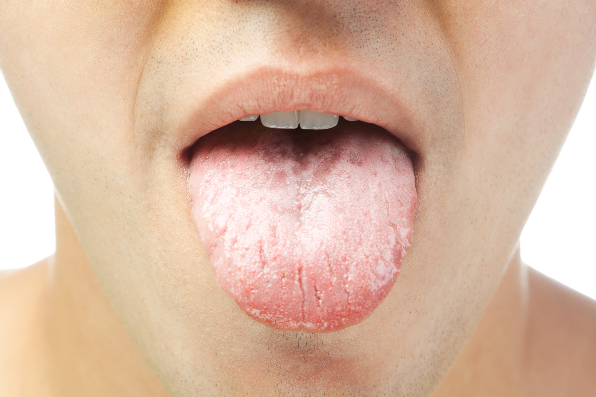 Trends and Demographics: Dry Mouth Trends and Demographics: Dry Mouth