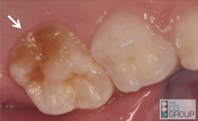 Reconsidering Molar Hypomineralization and “Chalky Teeth” Reconsidering Molar Hypomineralization and “Chalky Teeth”