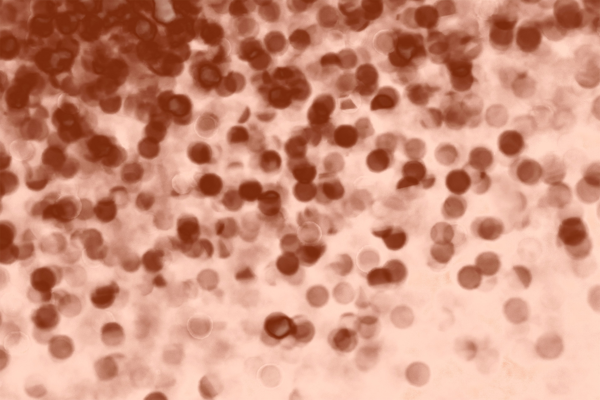 Measles: Concerns and Implications for Dental Professionals