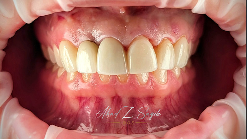 A smile makeover; going from Point A to Point B