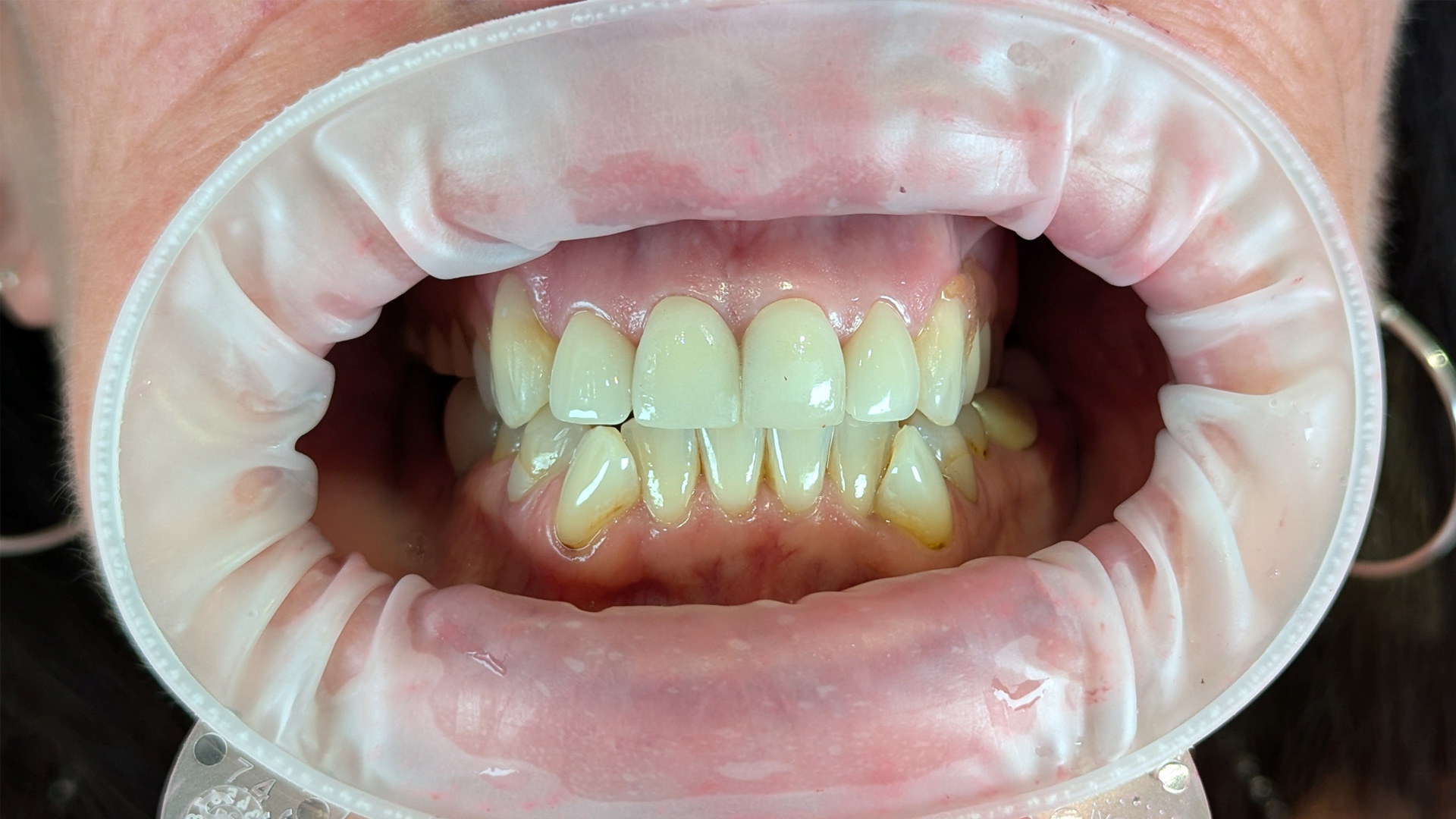 Caries Management in the Aesthetic Region and Producing an Excellent Aesthetic Outcome with Prosthodontics Caries Management in the Aesthetic Region and Producing an Excellent Aesthetic Outcome with Prosthodontics